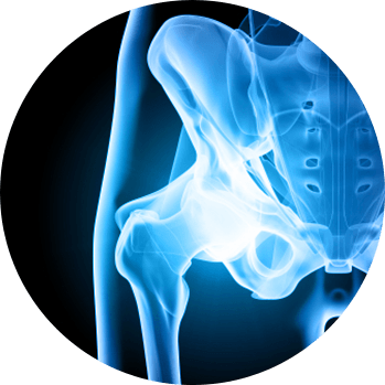 Hip Joint Replacement